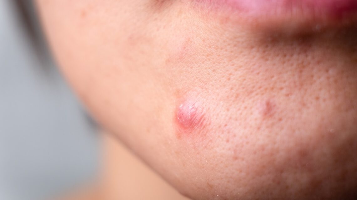 acne skin
