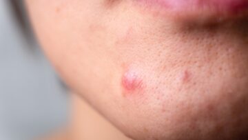 acne skin